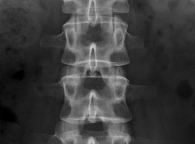 Lumbar Vertebrae Anatomy Xray 4073